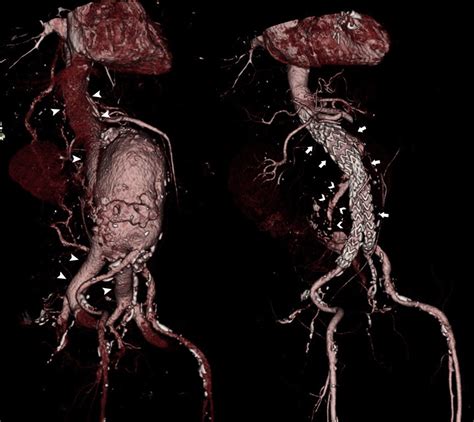 Abdominal Aortic Aneurysm With Aortocaval Fistulastaged Endovascular