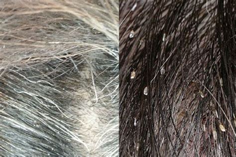 Dandruff Scalp Scabs Driverlayer Search Engine