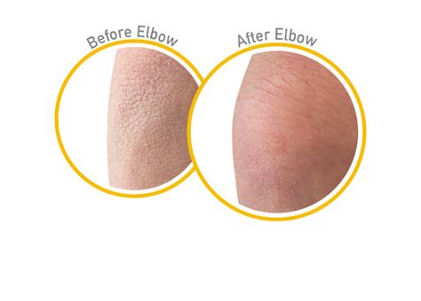 Skin Repair Before And After Use Guaranteed Relief For Extremely