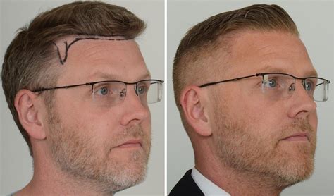 Female Hair Transplant Before And After Photos Park Art