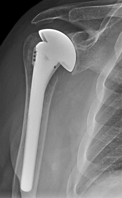 Uw Shoulder And Elbow Academy Shoulder Joint Replacement Humeral