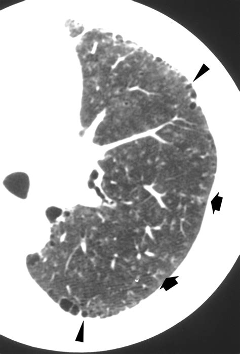High Resolution Ct Of Asbestosis And Idiopathic Pulmonary Fibrosis Ajr