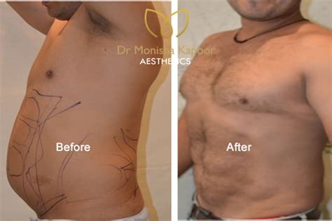 Liposuction And Six Pack Abs Surgery In Delhi By Dr Monisha Kapoor