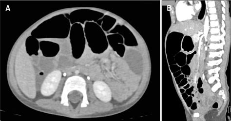 Contrast Enhanced Abdominal Ct Scan Performed During The Diagnostic