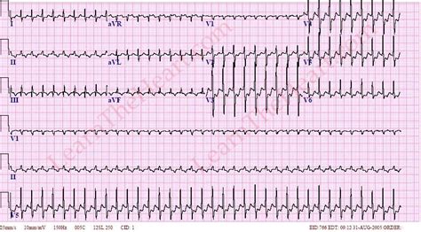 Paroxysmal supraventricular tachycardia (svt, psvt). ECG Case #8 - Question #1 Answer | LearntheHeart.com