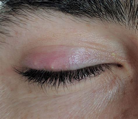 What Is A Stye And How Do I Cure It Safely Lasikplus