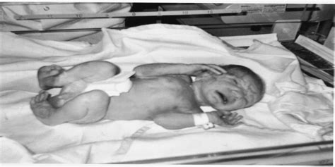 Neonatal Marfan Syndrome Clinical Report And Review Of The Clinical Dysmorphology
