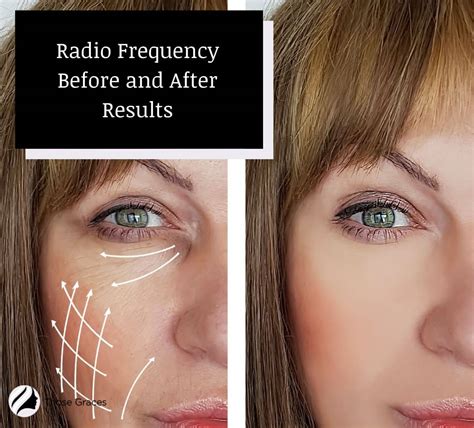 Radio Frequency Before And After Incredible Results Videos