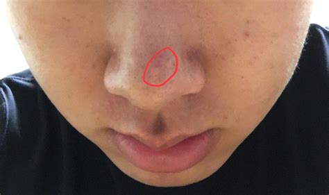 Skin Concerns How Do I Get Rid Of These Skin Colored Bumps On My Nose