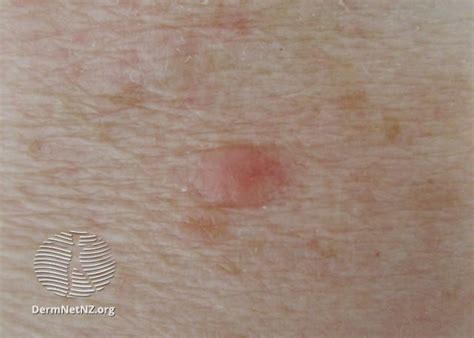 Filenodular Basal Cell Carcinoma Arm Dermnet Nz Nbcc Arm 25dn