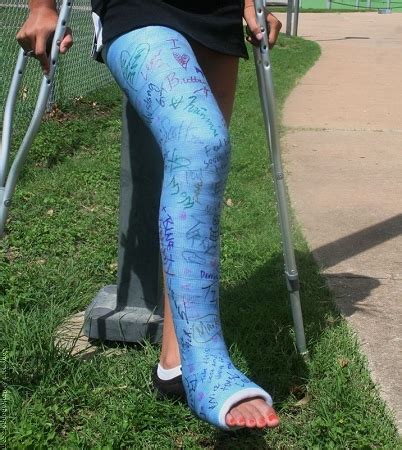 Long Leg Cast Medical Cast