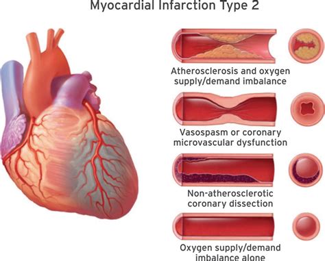 Diagram Pathophysiology Of Myocardial Infarction Ppt Interleukin 1