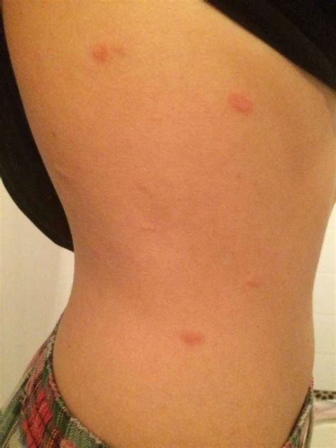Itchy Red Bump On Skin