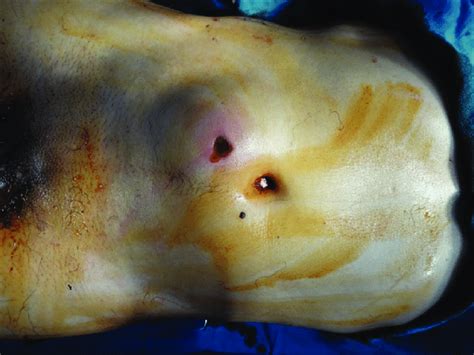 Entry Wound Of Gunshot Wound Right Side Of The Umbilicus
