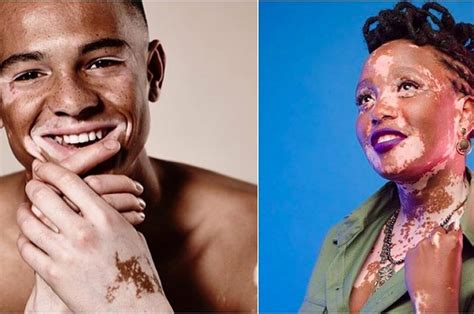 17 Absolutely Stunning People Living With Vitiligo