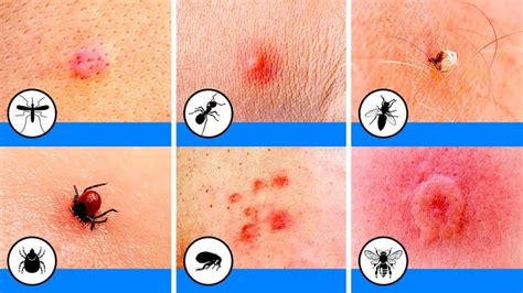 Tips To Prevent And Treat Bug Bites Upstate Dermatology
