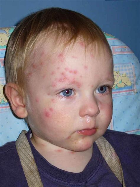 Chicken Pox Rash In Babies Pictures Symptoms And Pictures