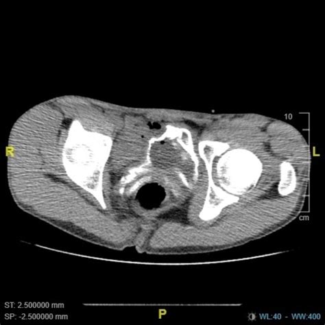 Urinary Schistosomiasis A Case Of Late Presentation Bmj Case Reports