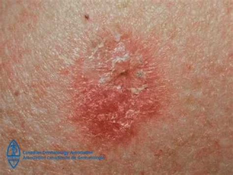 Here is an image of what melanoma looks like. Sun Safety - Spotting skin cancer (5min 25sec) - YouTube