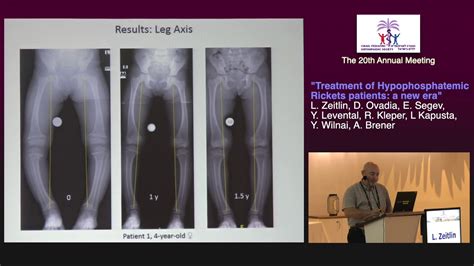 Day 2 4 Treatment Of Hypophosphatemic Rickets Patients A New Era