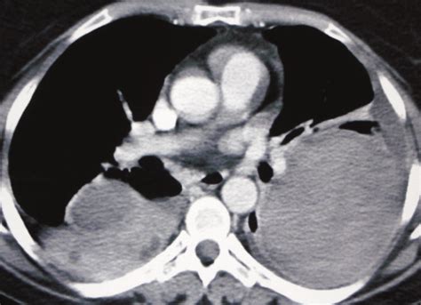 Chest Ct Scan With Iv Contrast Showing Bilateral Enhancing