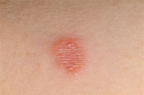 Ringworm In Kids Diagnosis And Treatment