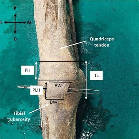 Figure Showing The Various Measurements Of The Patella And Patellar