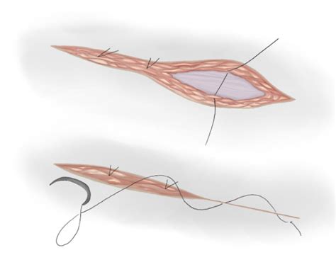 Congenital Hydrocele And Inguinal Hernia Pediatric Urology Book