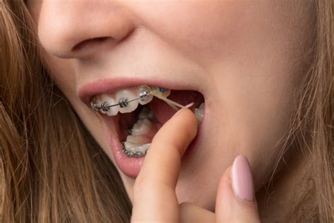 How Important Is It To Wear Your Orthodontic Rubber Bands Belmar Orthodontics