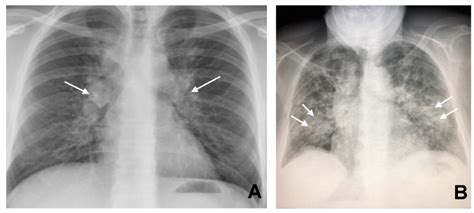 Jcm Free Full Text Ct Findings In Pulmonary And Abdominal