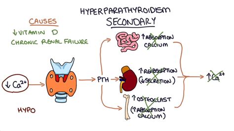Understanding Hyperparathyroidism Youtube