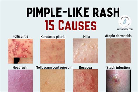Pimple Like Rash 15 Skin Bumps That Look Like Pimples