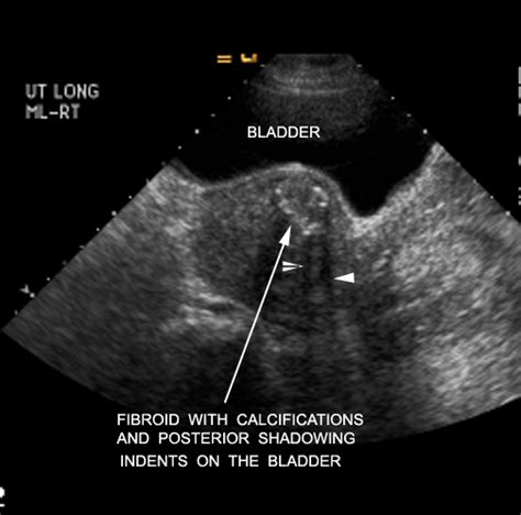 Us Fibroid With Calcifications