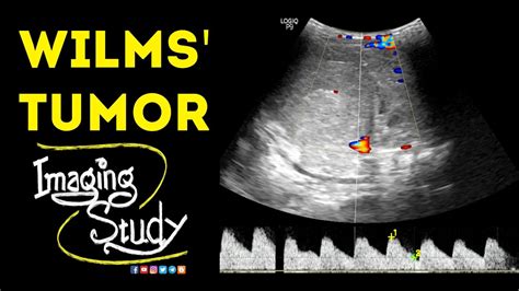 Wilms Tumor Ultrasound Case 47 Youtube
