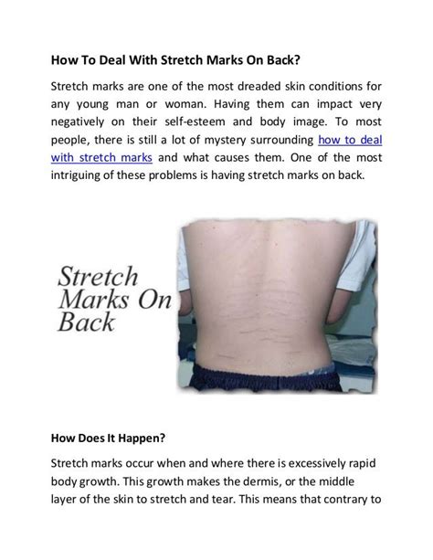 How To Deal With Stretch Marks On Back
