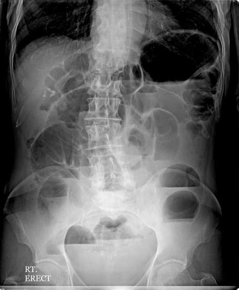 Small Bowel Obstruction Gastrointestinal Medbullets Step 23