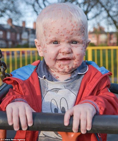Oscar Langham 10 Months Old Is Covered In Angry Red Boils Due To A