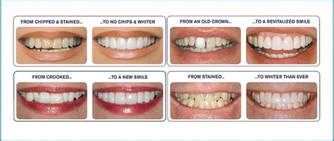 Dental Veneers Complete Guide On Dental Veneers