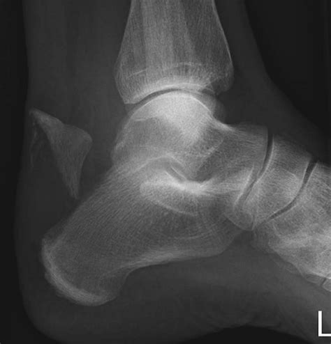 Avulsion Fracture Of The Calcaneal Tuberosity Case Report And