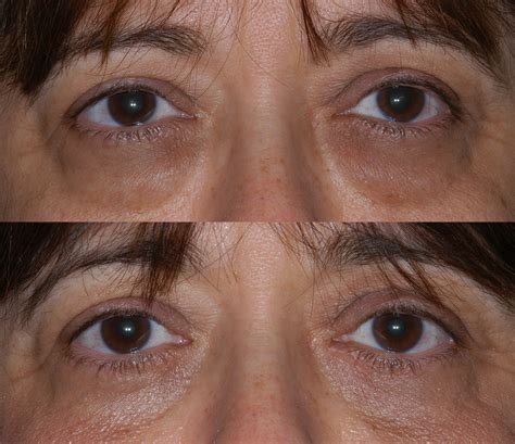 Lower Lid Blepharoplasty Before And After Center For Excellence In