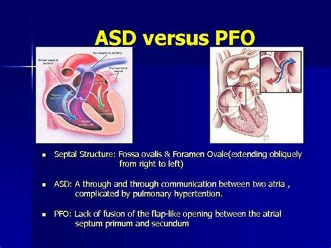 Asd Vs Pfo