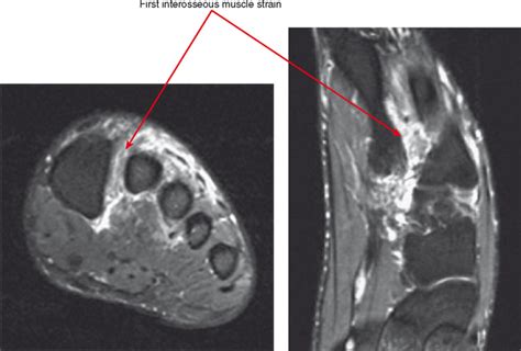 Neuropathies around the elbow joint. IMAGING OF THE FOREFOOT AND MIDFOOT | Radiology Key