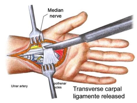 Carpal Tunnel Surgery Video The Carpal Solution