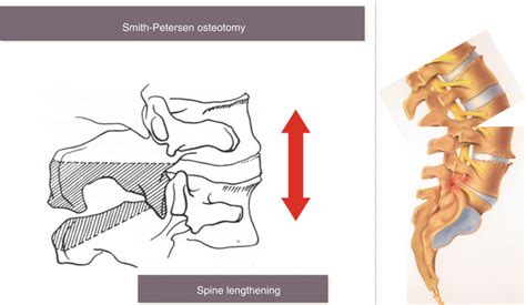 Posterior Impaction Osteotomy For Correction Of Sagittal Imbalance In