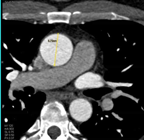 Calcified Aortic Valve With Dilated Ascending Aorta Cardiac Case