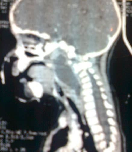 Ct Scan Sagittal View That Shows A Retropharyngeal Abscess With