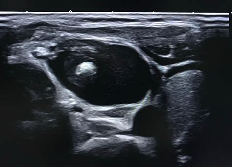 Vietnamese Medic Ultrasound Case Ultrasound Of A Cystic Neck Mass