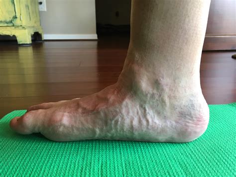 Diabetic Neuropathy The Foot And Ankle Online Journal