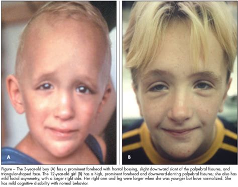 Children With Gigantism Hypotonia And An Unusual Facial Appearance