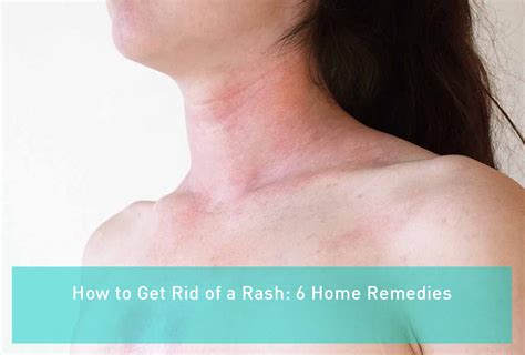 Step By Step Instructions To Get Rid Of A Rash 6 Home Remedies Çok